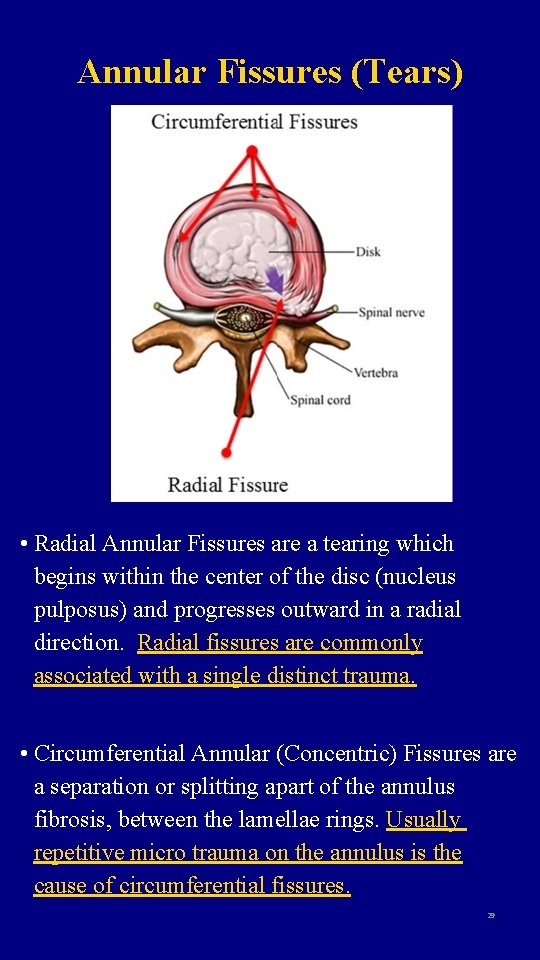 Annular Fissures (Tears) • Radial Annular Fissures are a tearing which begins within the