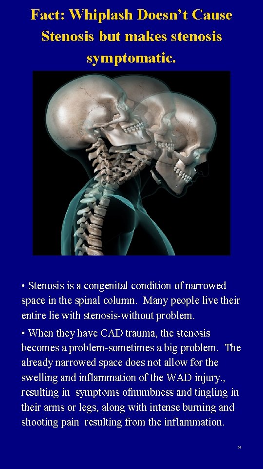 Fact: Whiplash Doesn’t Cause Stenosis but makes stenosis symptomatic. • Stenosis is a congenital