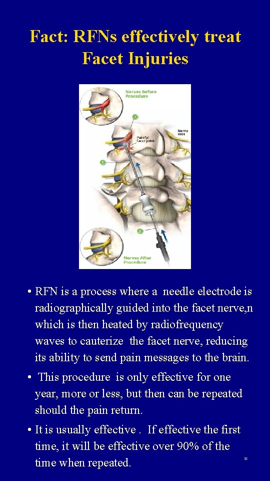 Fact: RFNs effectively treat Facet Injuries • RFN is a process where a needle