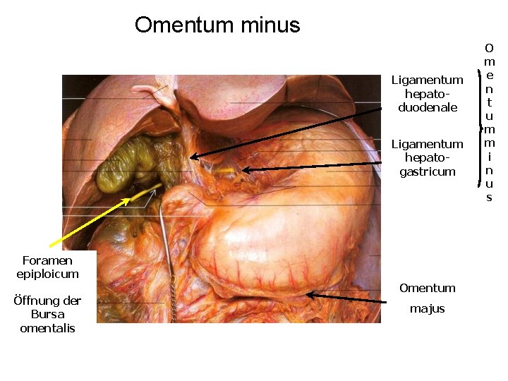 Omentum minus Ligamentum hepatoduodenale Ligamentum hepatogastricum Foramen epiploicum Öffnung der Bursa omentalis Omentum majus