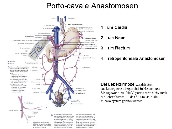 Porto-cavale Anastomosen 1. um Cardia 2. um Nabel 3. um Rectum 4. retroperitoneale Anastomosen