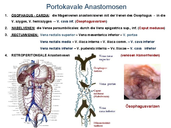 Portokavale Anastomosen 1. ÖSOPHAGUS - CARDIA: die Magenvenen anastomisieren mit der Venen des Ösophagus