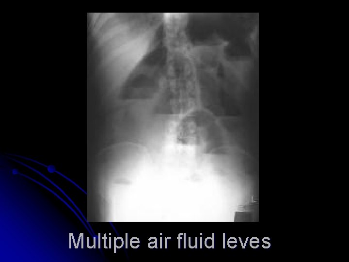 Multiple air fluid leves 