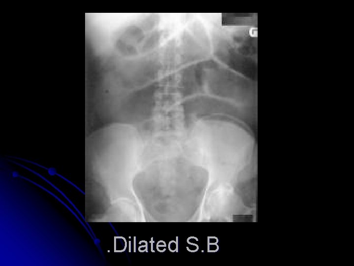 . Dilated S. B 