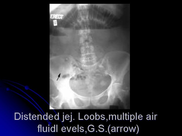 Distended jej. Loobs, multiple air fluidl evels, G. S. (arrow) 
