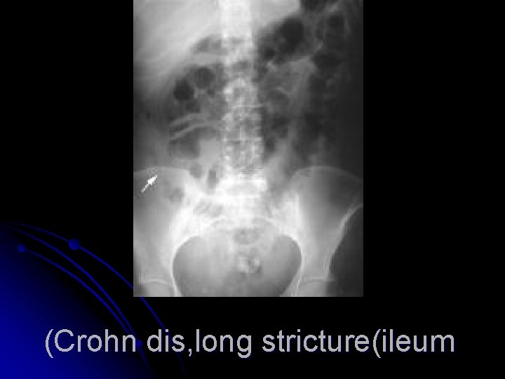 (Crohn dis, long stricture(ileum 