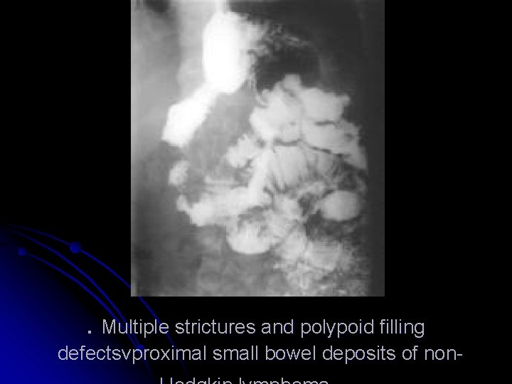 . Multiple strictures and polypoid filling defectsvproximal small bowel deposits of non- 