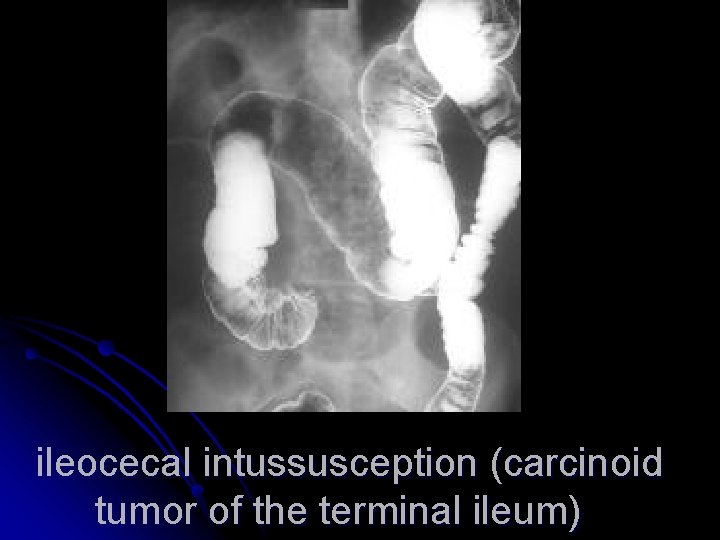 ileocecal intussusception (carcinoid tumor of the terminal ileum) 