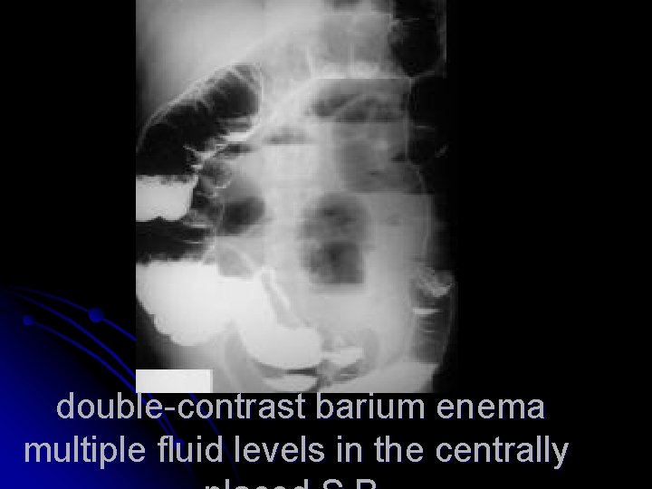  double-contrast barium enema multiple fluid levels in the centrally 