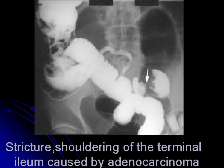 Stricture, shouldering of the terminal ileum caused by adenocarcinoma 