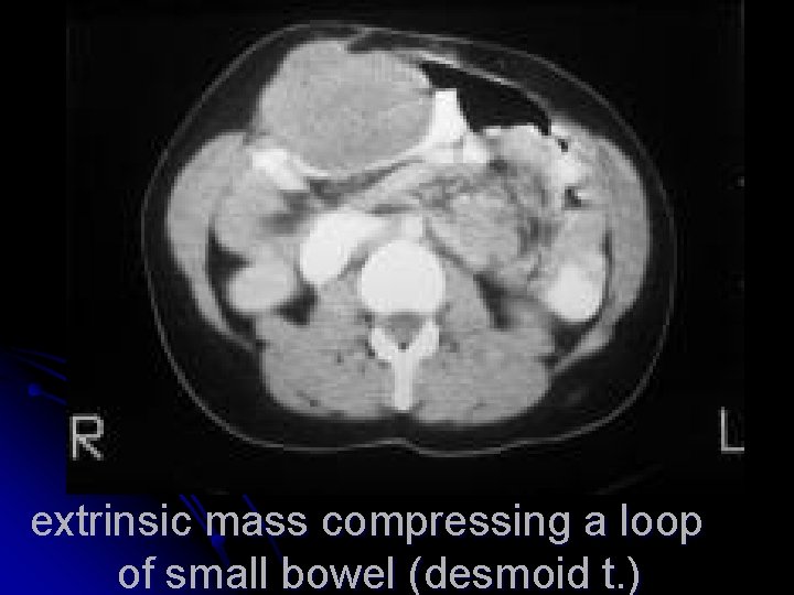 extrinsic mass compressing a loop of small bowel (desmoid t. ) 