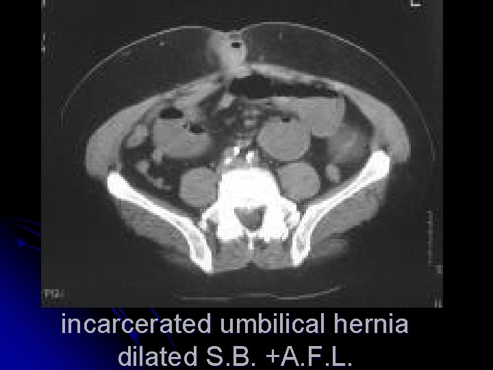 incarcerated umbilical hernia dilated S. B. +A. F. L. 