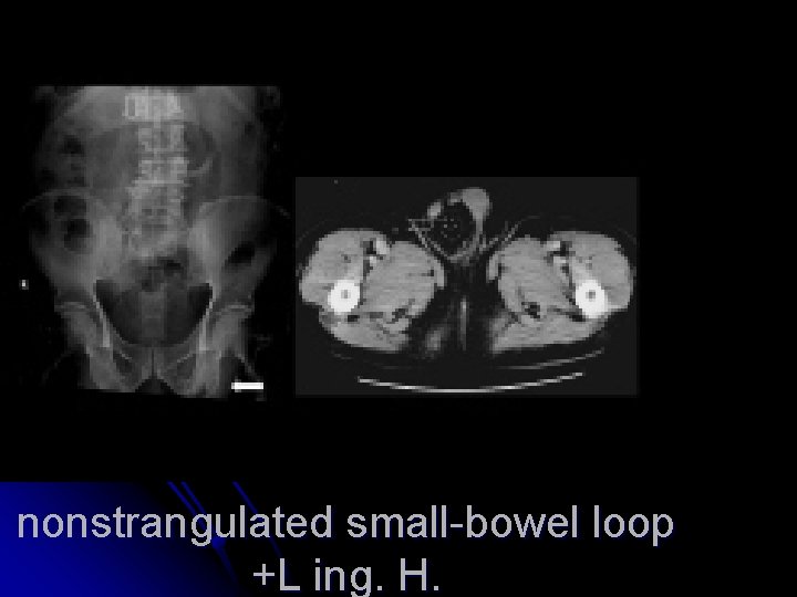 nonstrangulated small-bowel loop +L ing. H. 