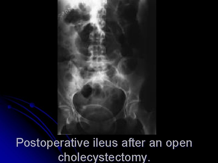Postoperative ileus after an open cholecystectomy. 