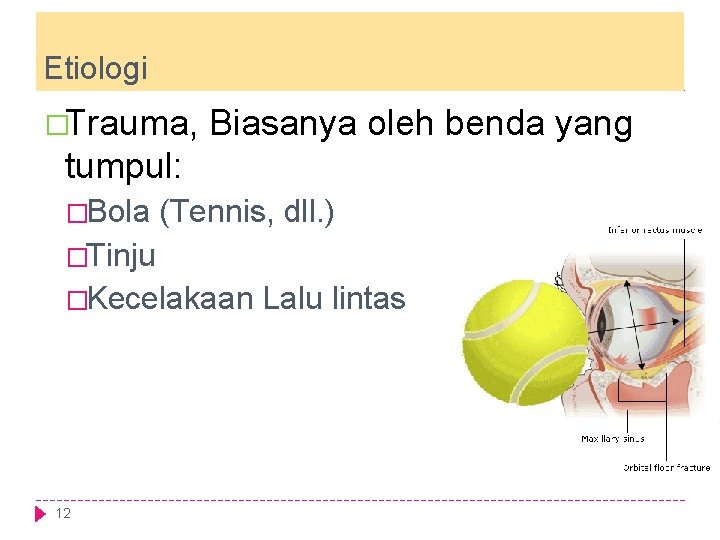 Etiologi �Trauma, Biasanya oleh benda yang tumpul: �Bola (Tennis, dll. ) �Tinju �Kecelakaan 12