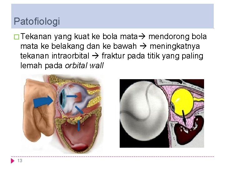 Patofiologi � Tekanan yang kuat ke bola mata mendorong bola mata ke belakang dan