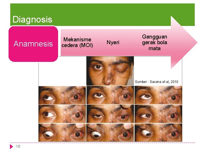 Diagnosis Anamnesis Mekanisme cedera (MOI) Nyeri Gangguan gerak bola mata Sumber : Saxena et