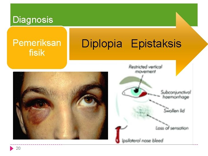 Diagnosis Pemeriksan fisik 20 Diplopia Epistaksis 