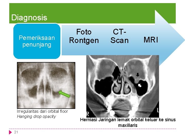 Diagnosis Pemeriksaan Pemeriksan penunjang fisik Irregularitas dari orbital floor Hanging drop opacity 21 Foto