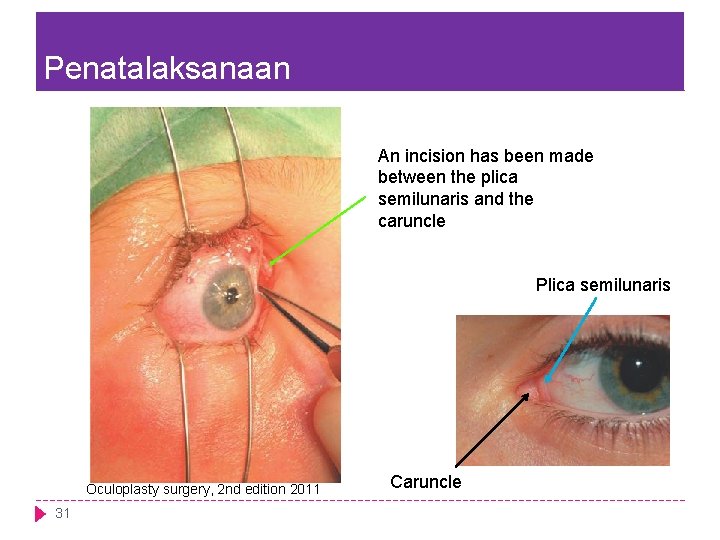 Penatalaksanaan An incision has been made between the plica semilunaris and the caruncle Plica