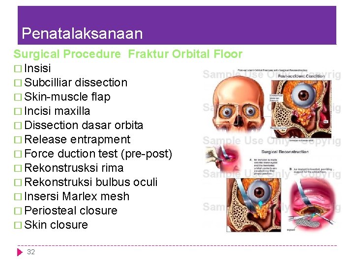 Penatalaksanaan Surgical Procedure Fraktur Orbital Floor � Insisi � Subcilliar dissection � Skin-muscle flap