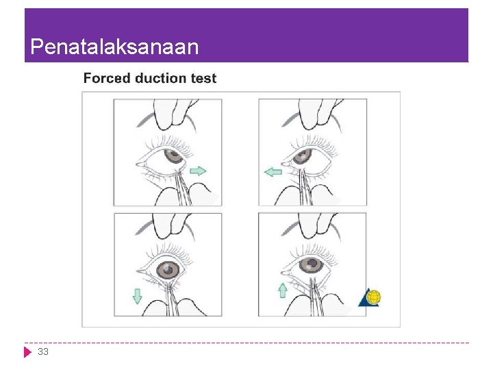 Penatalaksanaan 33 