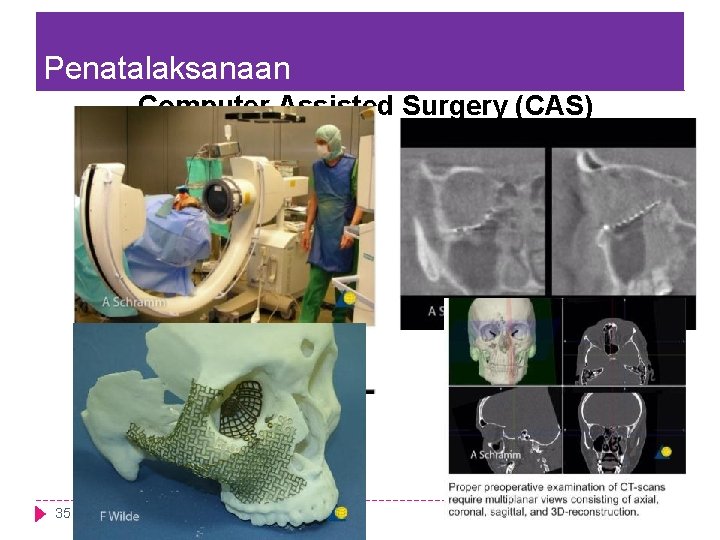 Penatalaksanaan Computer Assisted Surgery (CAS) 35 