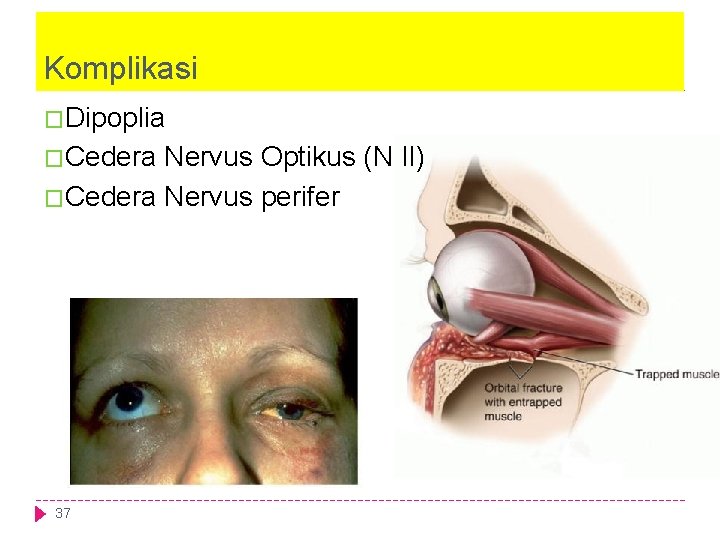 Komplikasi �Dipoplia �Cedera Nervus Optikus (N II) �Cedera Nervus perifer 37 