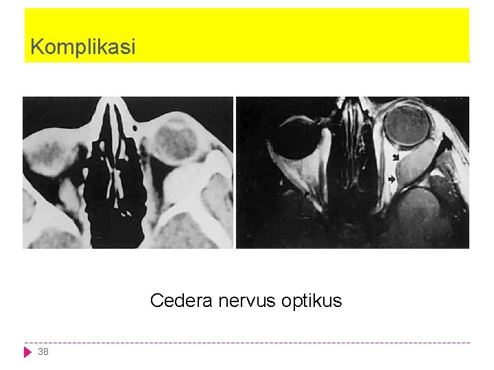 Komplikasi Cedera nervus optikus 38 