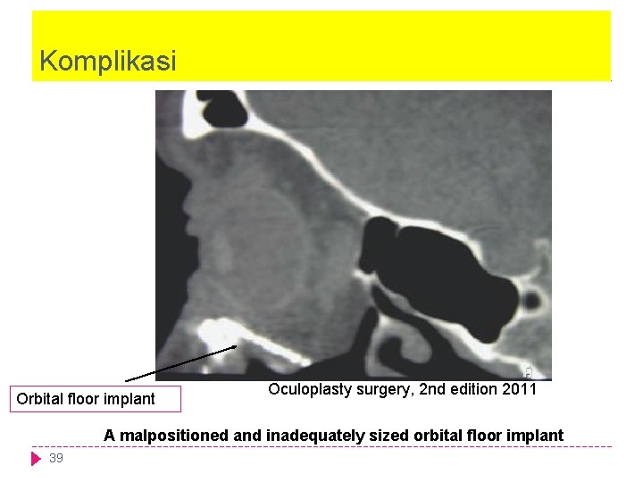 Komplikasi Orbital floor implant Oculoplasty surgery, 2 nd edition 2011 A malpositioned and inadequately