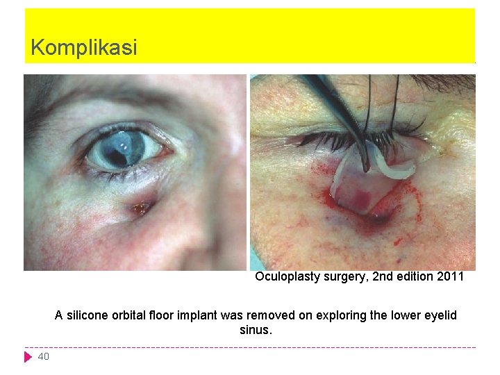 Komplikasi Oculoplasty surgery, 2 nd edition 2011 A silicone orbital floor implant was removed