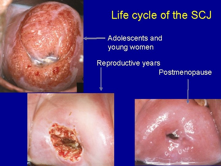 Life cycle of the SCJ Adolescents and young women Reproductive years Postmenopause 