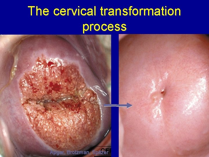 The cervical transformation process Apgar, Brotzman, Spitzer 