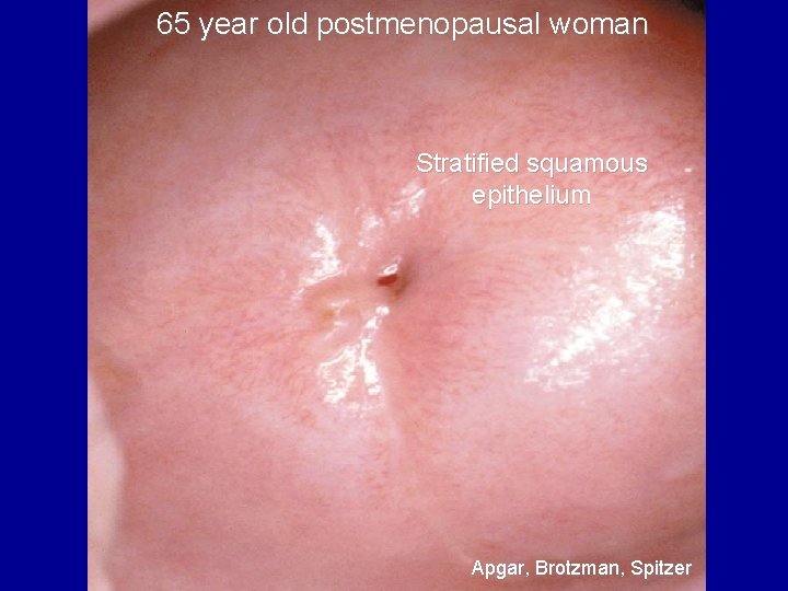  65 year old postmenopausal woman Stratified squamous epithelium Apgar, Brotzman, Spitzer 