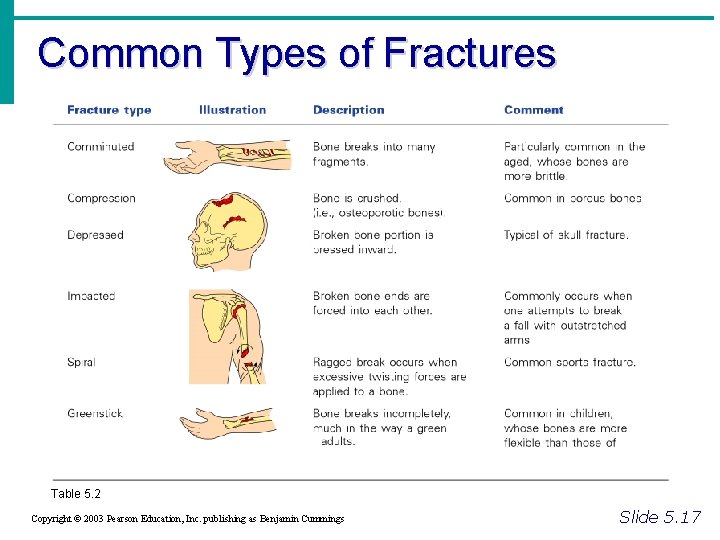 Common Types of Fractures Table 5. 2 Copyright © 2003 Pearson Education, Inc. publishing