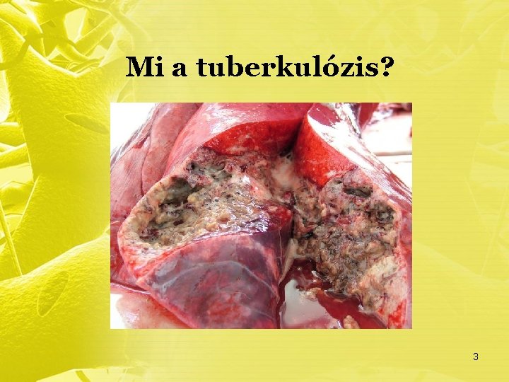 Mi a tuberkulózis? 3 