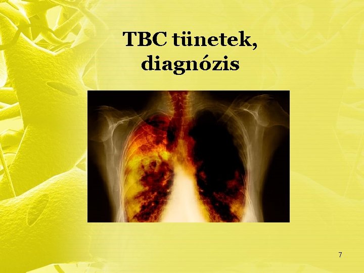 TBC tünetek, diagnózis 7 