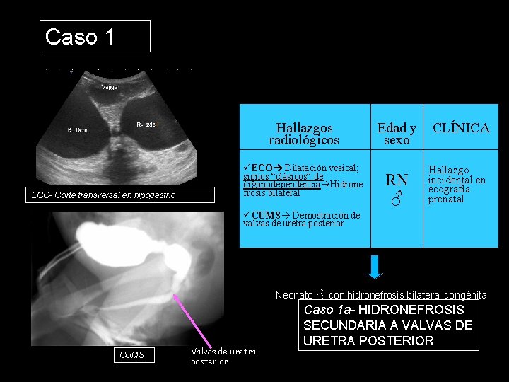 Caso 1 Hallazgos radiológicos ECO- Corte transversal en hipogastrio ECO Dilatación vesical; signos “clásicos”