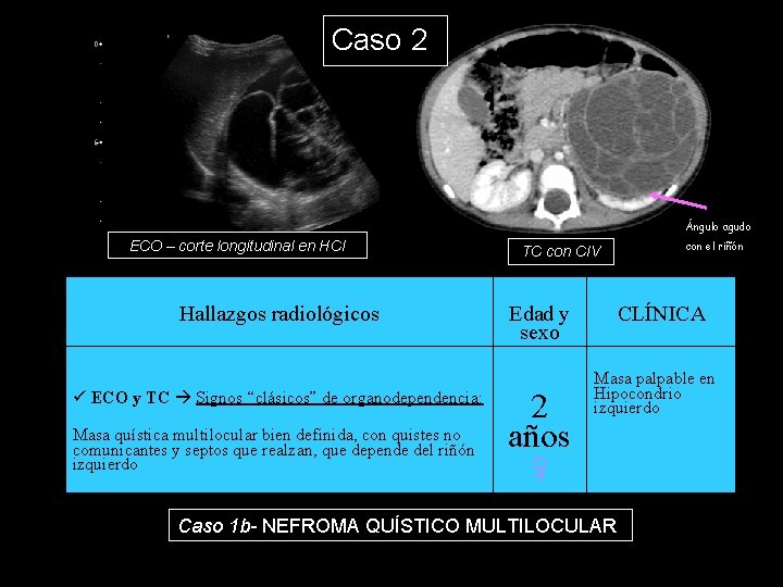 Caso 2 Ángulo agudo ECO – corte longitudinal en HCI Hallazgos radiológicos ECO y