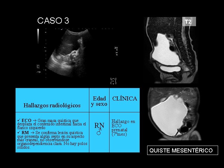 CASO 3 Hallazgos radiológicos ECO Gran masa quística que desplaza el contenido intestinal hacia