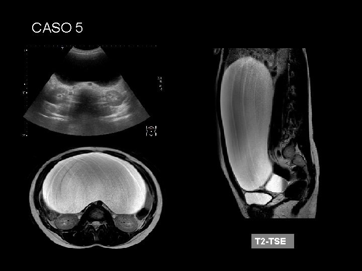 CASO 5 T 2 -TSE 