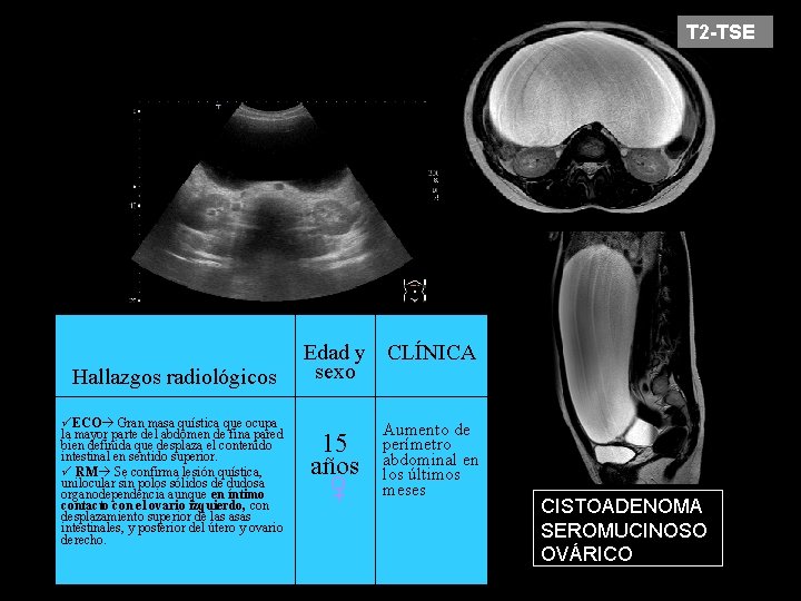 T 2 -TSE Hallazgos radiológicos ECO Gran masa quística que ocupa la mayor parte