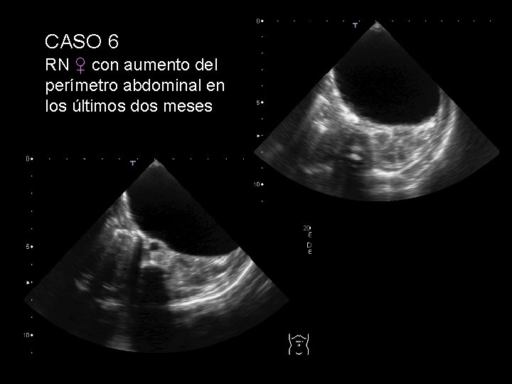 CASO 6 RN ♀ con aumento del perímetro abdominal en los últimos dos meses