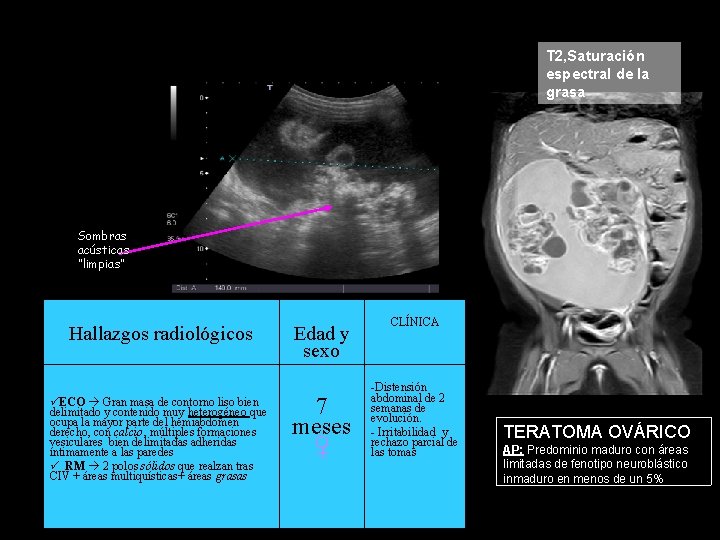 T 2, Saturación espectral de la grasa Sombras acústicas “limpias” Hallazgos radiológicos ECO Gran