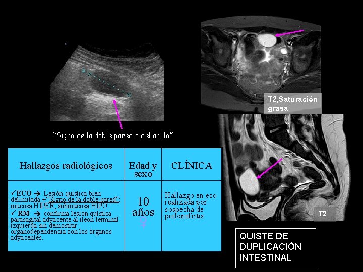 T 2, Saturación grasa “Signo de la doble pared o del anillo” Hallazgos radiológicos