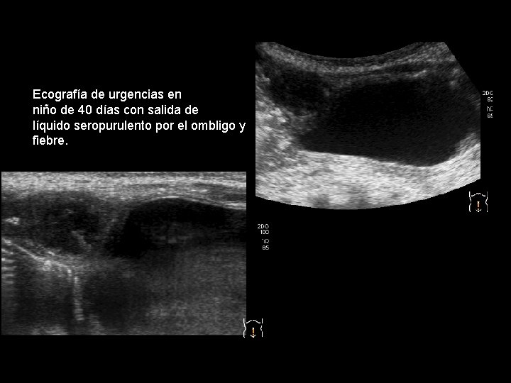 Ecografía de urgencias en niño de 40 días con salida de líquido seropurulento por