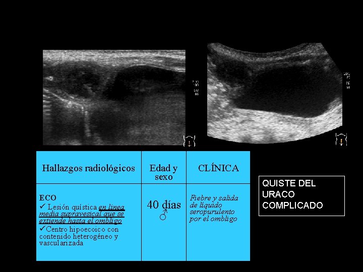 Hallazgos radiológicos ECO Lesión quística en linea media supravesical que se extiende hasta el