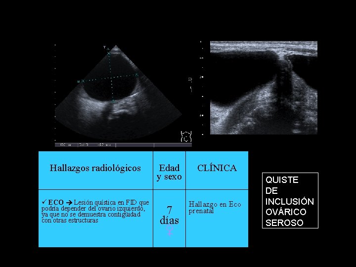 Hallazgos radiológicos ECO Lesión quística en FID que podría depender del ovario izquierdo, ya