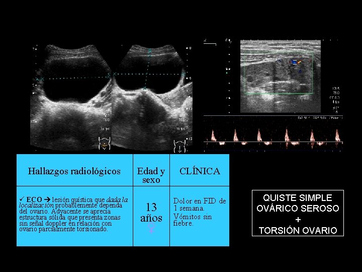 Hallazgos radiológicos ECO lesión quística que dada la localización probablemente dependa del ovario. Adyacente