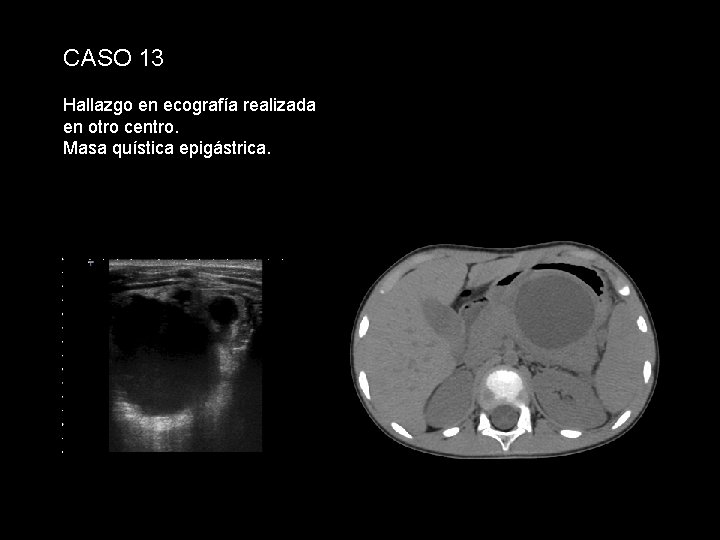 CASO 13 Hallazgo en ecografía realizada en otro centro. Masa quística epigástrica. 